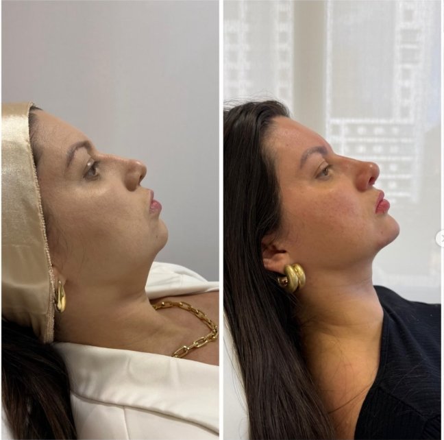 Antes e depois — perfiloplastia