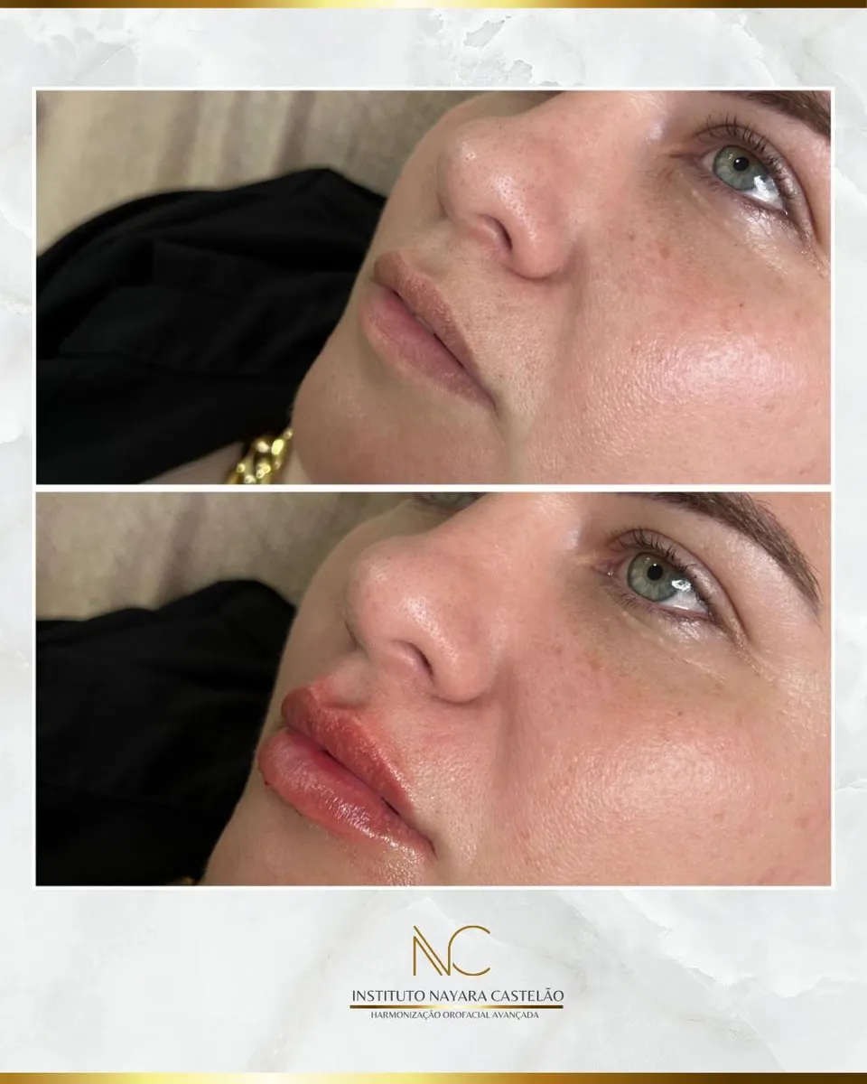 Antes e depois — preenchimento labial