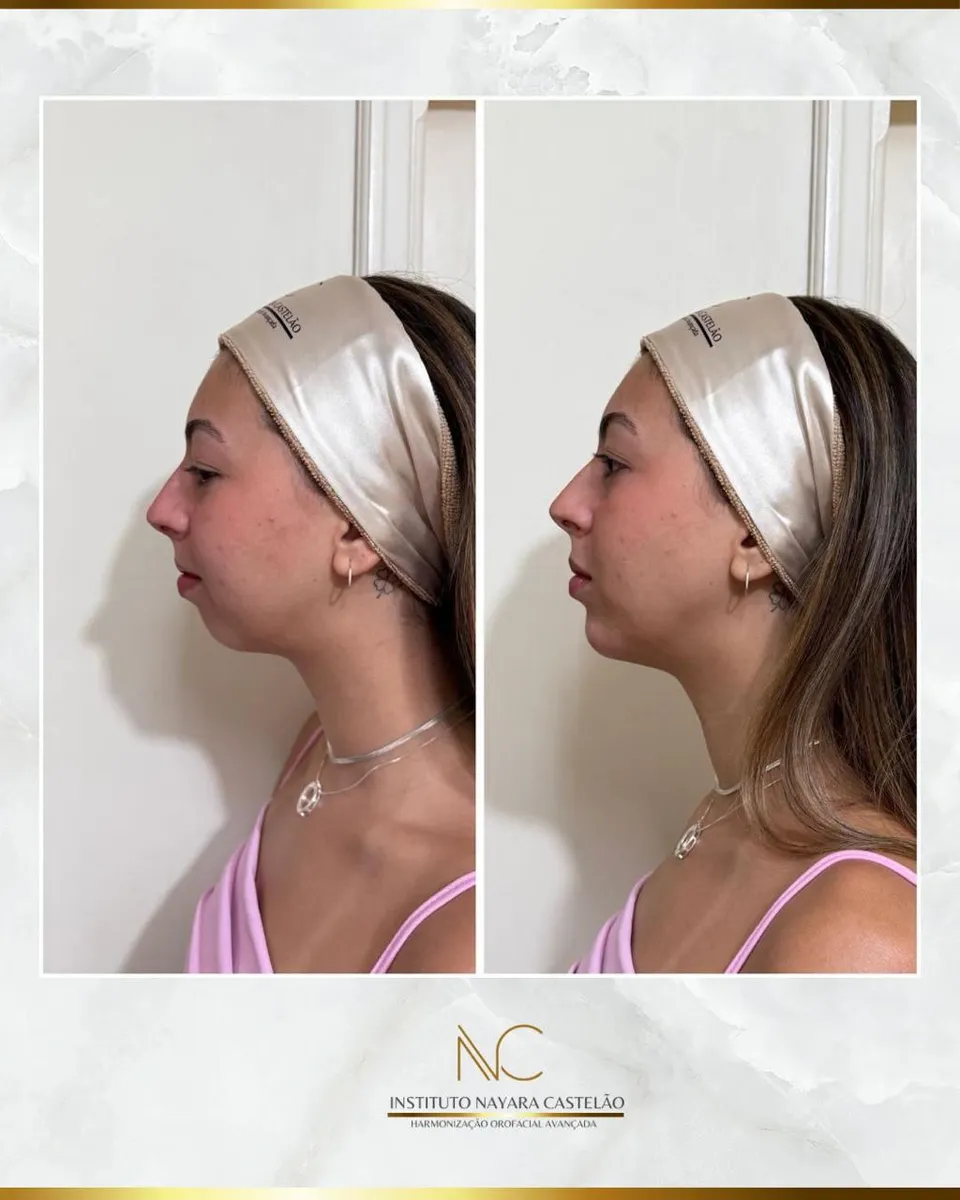 Antes e depois — preenchimento de mento