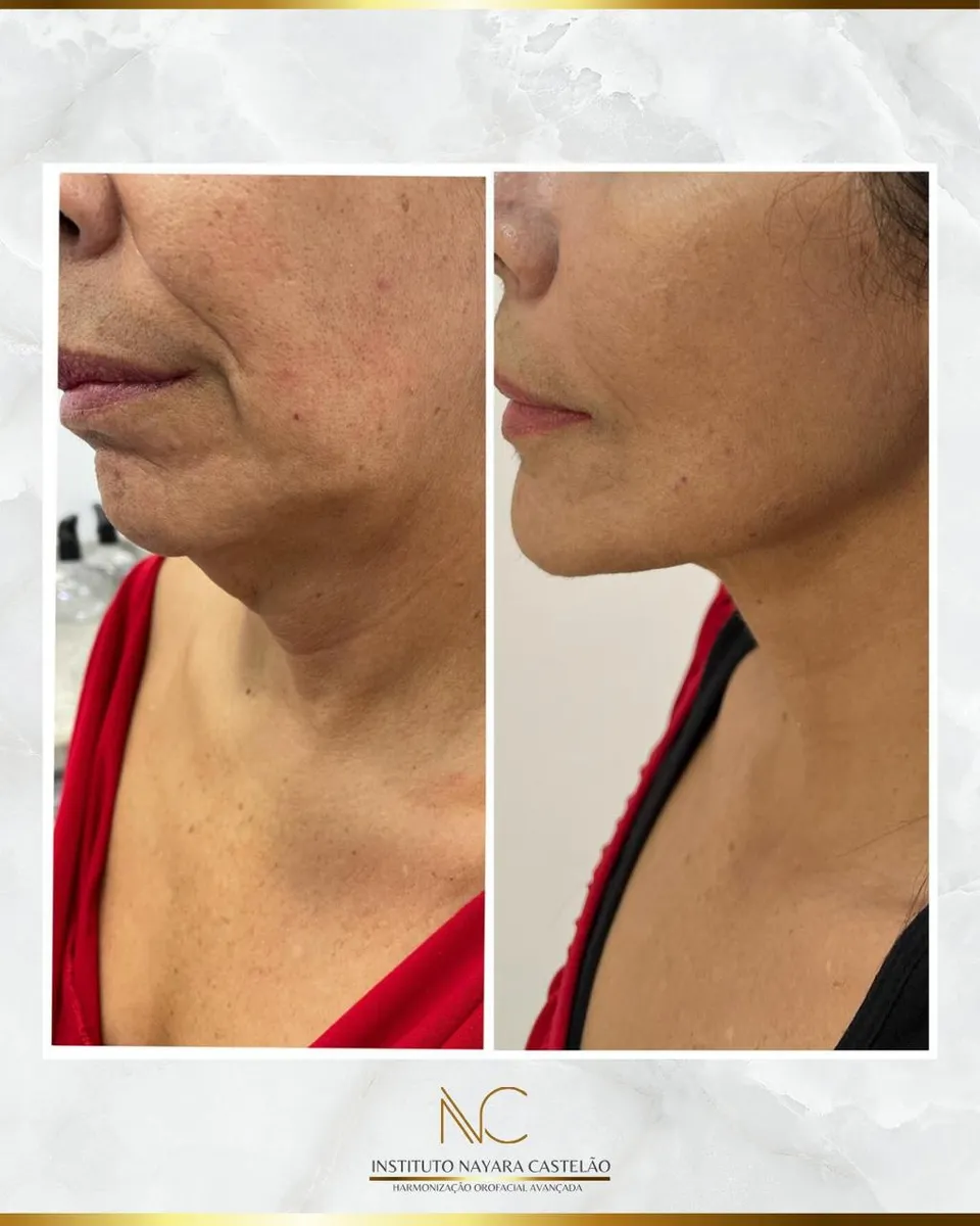Antes e depois — bioestimulador de colágeno e fios de PDO