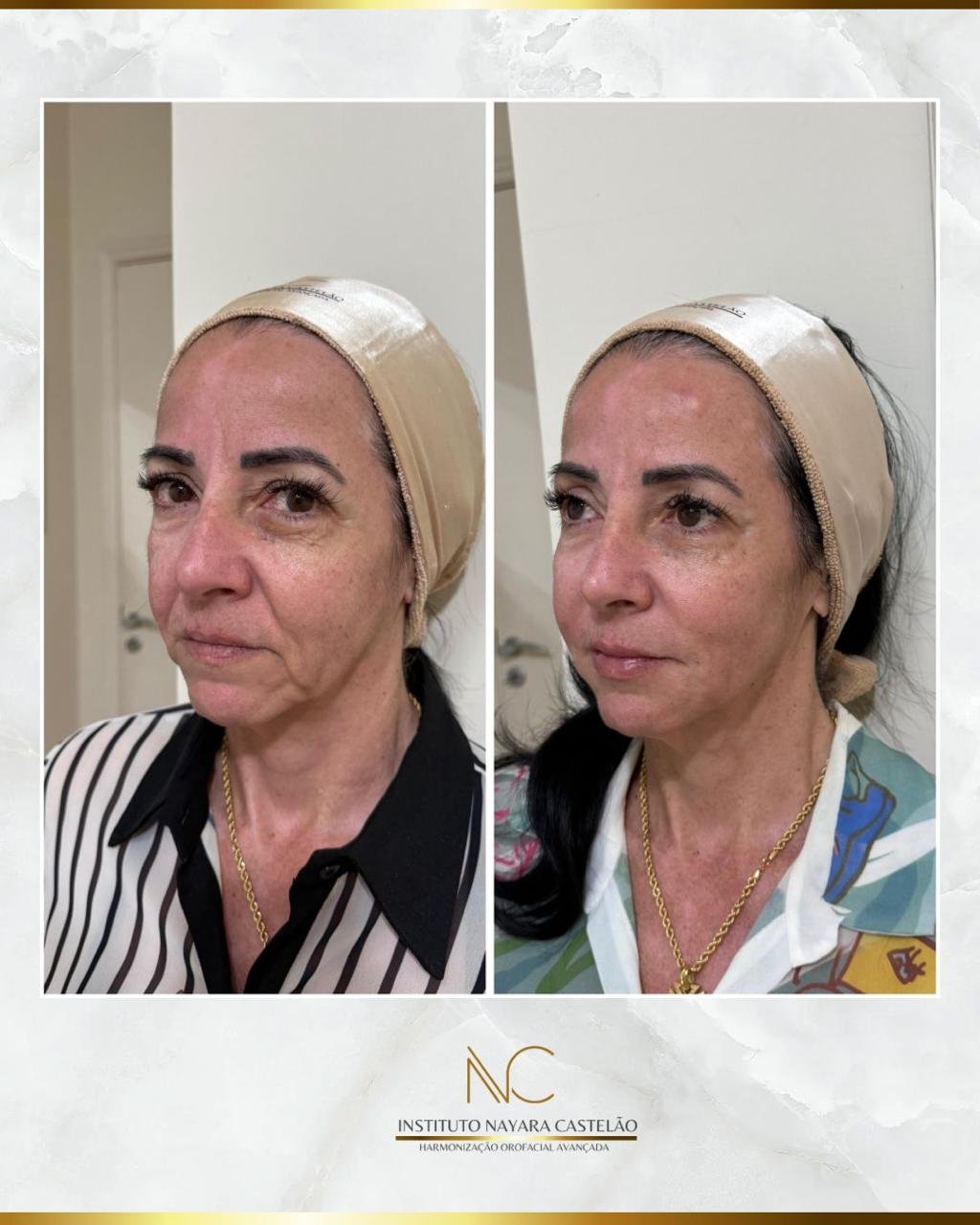 Antes e depois — harmonização facial completa